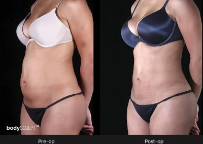 BodyTite Liposuction for Women - Before & After Photos