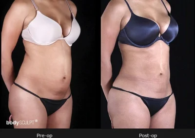 BodyTite Liposuction