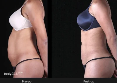 BodyTite Liposuction