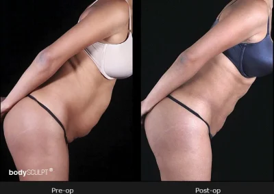 BodyTite Liposuction