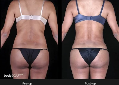 BodyTite Liposuction