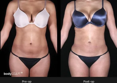 BodyTite Liposuction