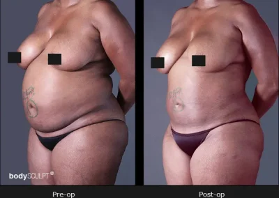 BodyTite Liposuction