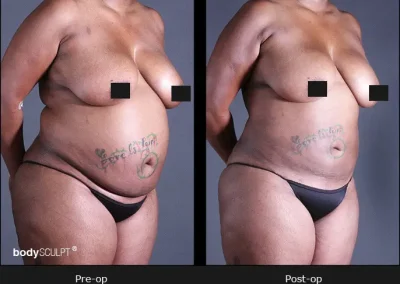 BodyTite Liposuction