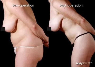 BodyTite Liposuction
