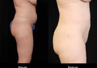 BodyTite Liposuction for Women - Before & After Photos