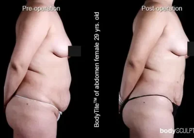 BodyTite Liposuction