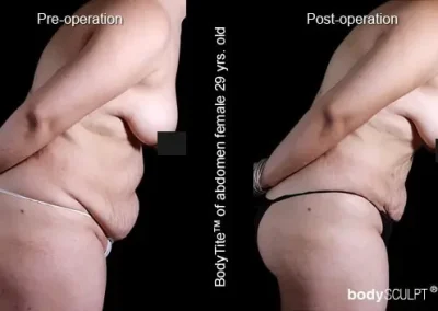 BodyTite Liposuction