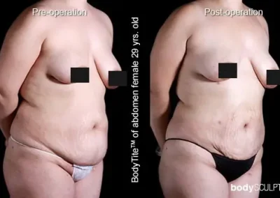 BodyTite Liposuction