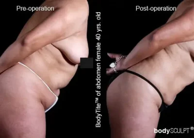 BodyTite Liposuction