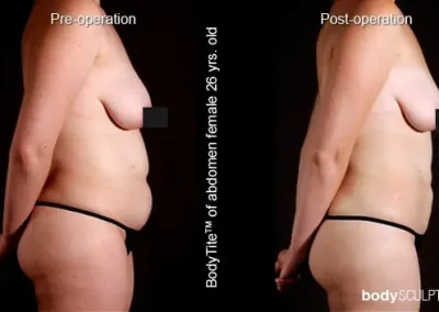 BodyTite Liposuction