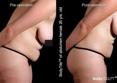 BodyTite Liposuction