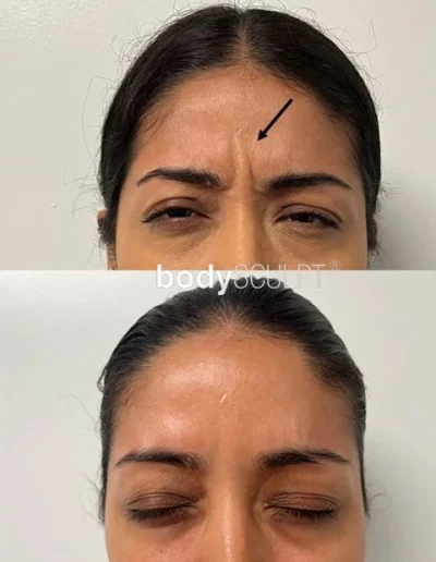 Botox Treatments – Before and After Photos