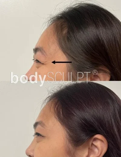 Botox Treatments