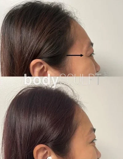 Botox Treatments – Before and After Photos
