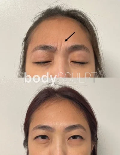 Botox Treatments – Before and After Photos