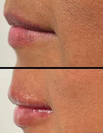 Botox Treatments