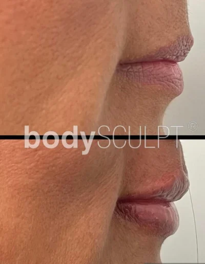 Botox Treatments