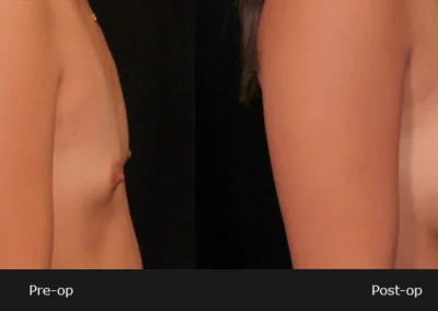 Breast Augmentation – Before & After Photos