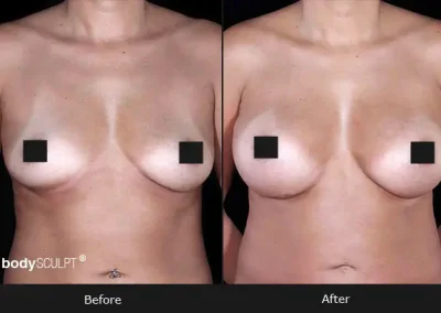 Breast Augmentation – Before & After Photos