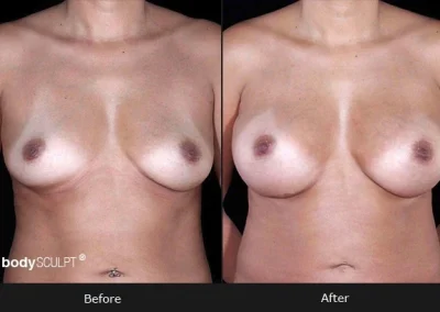 Breast Augmentation – Before & After Photos