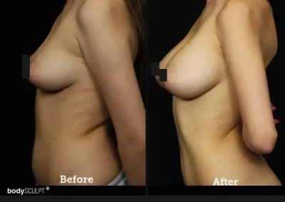 Breast Augmentation – Before & After Photos
