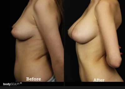 Breast Augmentation – Before & After Photos