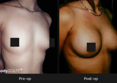 Breast Augmentation – Before & After Photos