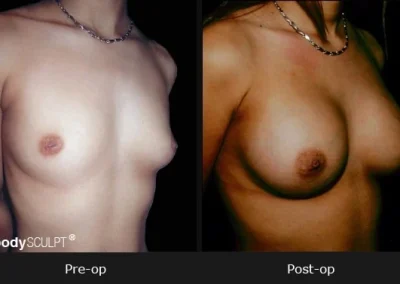 Breast Augmentation – Before & After Photos