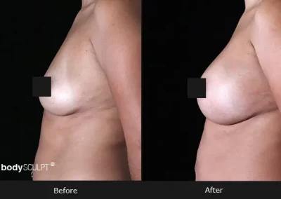 Breast Augmentation – Before & After Photos
