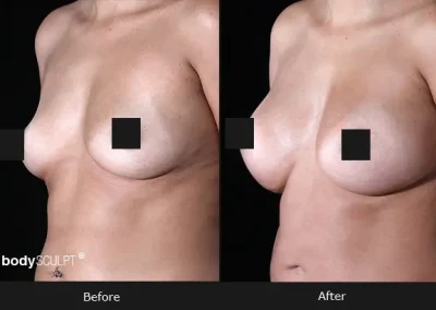 Breast Augmentation – Before & After Photos