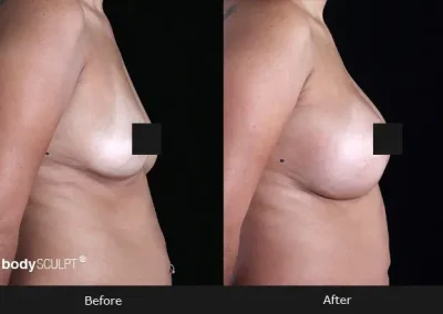 Breast Augmentation – Before & After Photos