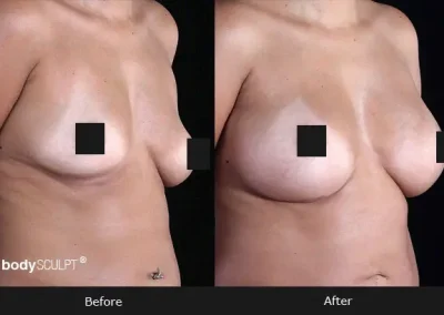 Breast Augmentation – Before & After Photos