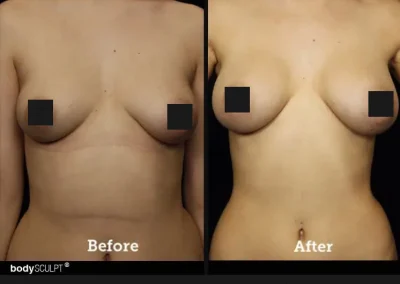 Breast Augmentation – Before & After Photos