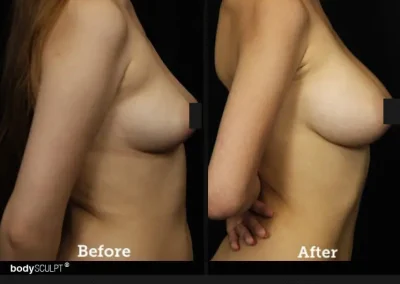 Breast Augmentation – Before & After Photos