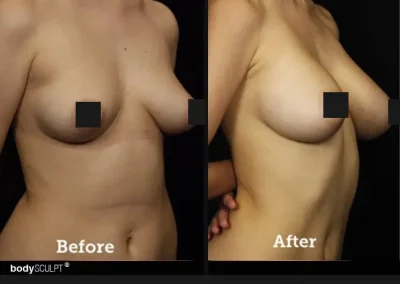 Breast Augmentation – Before & After Photos