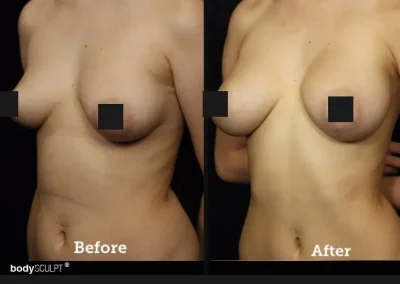 Breast Augmentation – Before & After Photos