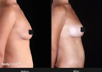 Composite Breast Augmentation – Patient 3 Before & After Photos