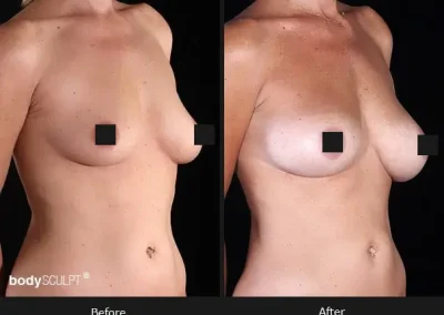 Composite Breast Augmentation – Patient 3 Before & After Photos