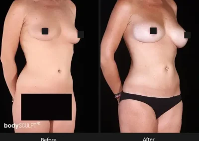 Composite Breast Augmentation – Patient 3 Before & After Photos