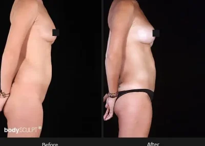 Composite Breast Augmentation – Patient 3 Before & After Photos