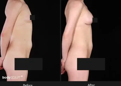 Composite Breast Augmentation – Before & After Photos