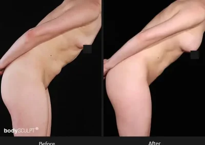 Composite Breast Augmentation – Before & After Photos