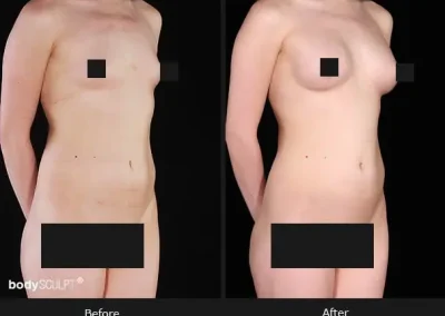 Composite Breast Augmentation – Before & After Photos