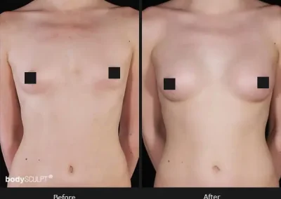 Composite Breast Augmentation – Before & After Photos