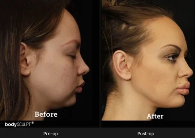 Chin Implant Surgery