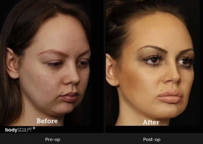 Chin Implant Surgery