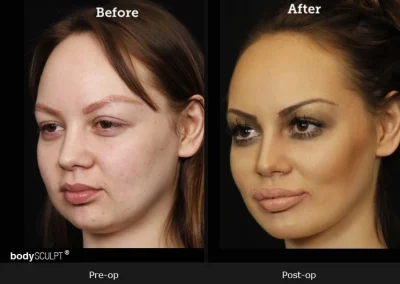 Chin Implant Surgery