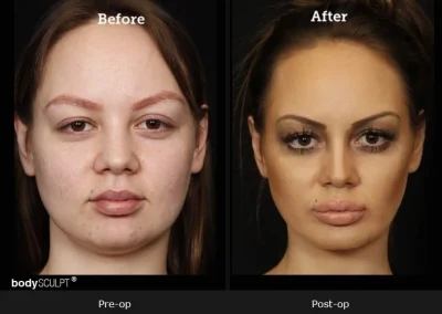 Chin Implant Surgery