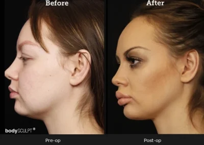 Chin Implant Surgery